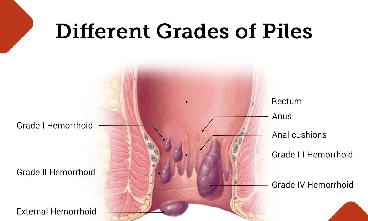 Stages of Piles