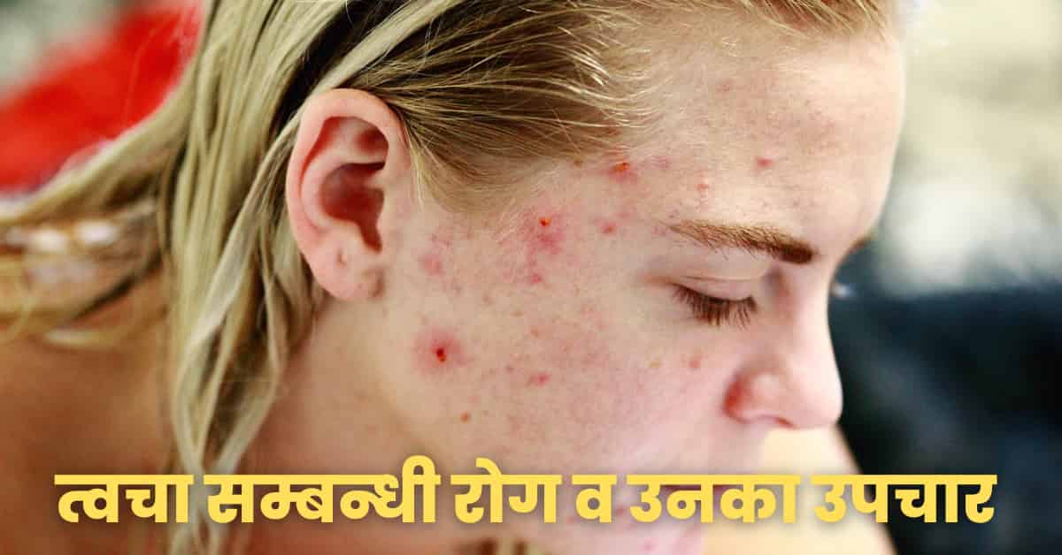 Skin Disease and its Treatment